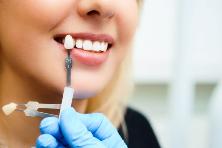 What is the difference between composite veneers and porcelain veneers?