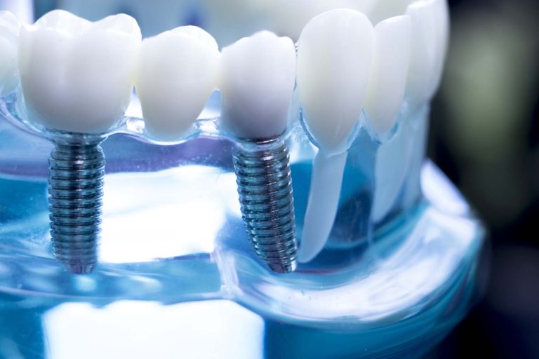 What are the pros and cons of dental crowns?