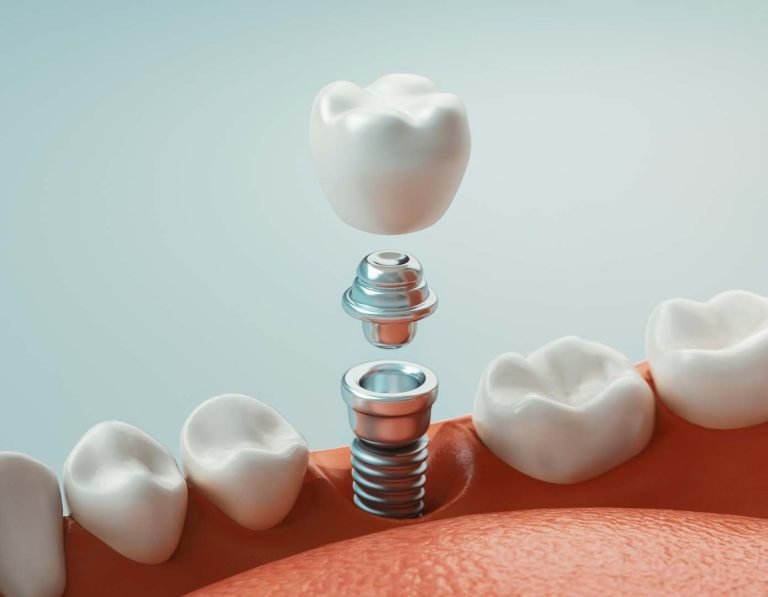 How long do dental crowns last?
