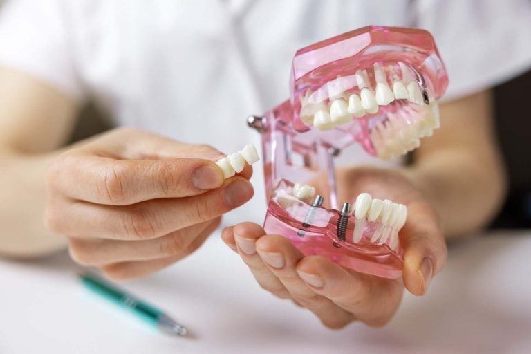 Is it better to get a dental implant or a bridge?