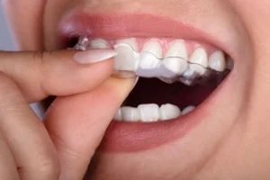 Radiant Dentistry - Clear Aligners